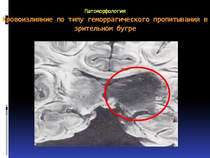 Патоморфология Кровоизлияние по типу геморрагического пропитывания в зрительном бугре 