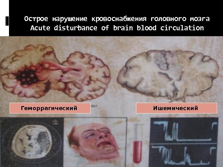 Острое нарушение кровоснабжения головного мозга Acute disturbance of brain blood circulation Геморрагический Ишемический 