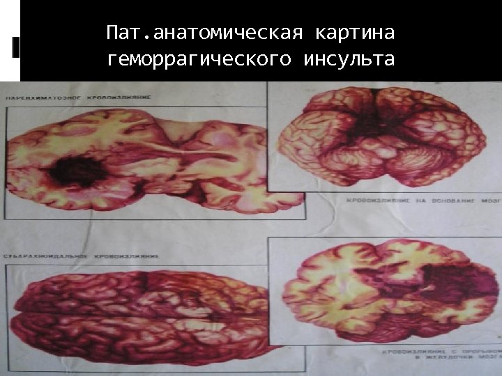 Пат. анатомическая картина геморрагического инсульта 