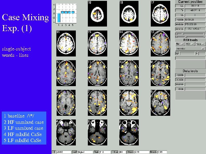 Case Mixing Exp. (1) single-subject words - lines 1 baseline /*/ 2 HF unmixed
