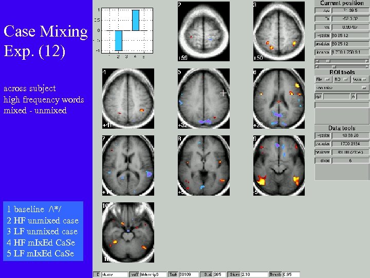 Case Mixing Exp. (12) across subject high frequency words mixed - unmixed 1 baseline