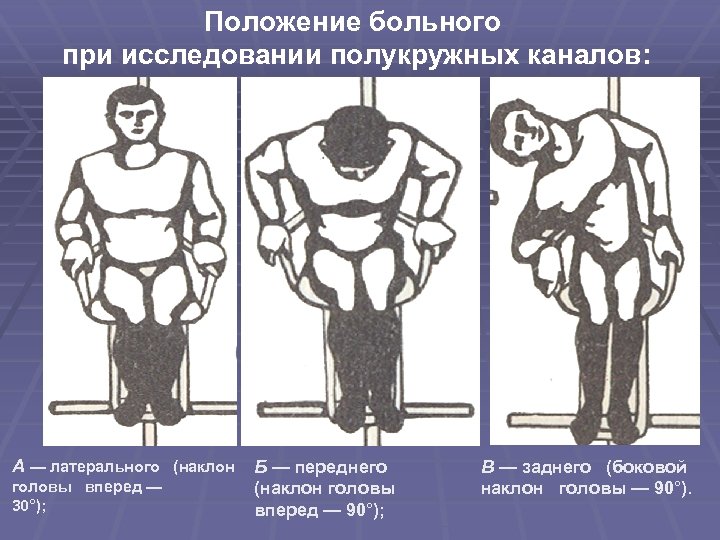 Положение больного при исследовании полукружных каналов: А — латерального (наклон головы вперед — 30°);