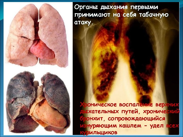 Органы дыхания первыми принимают на себя табачную атаку. Хроническое воспаление верхних дыхательных путей, хронический