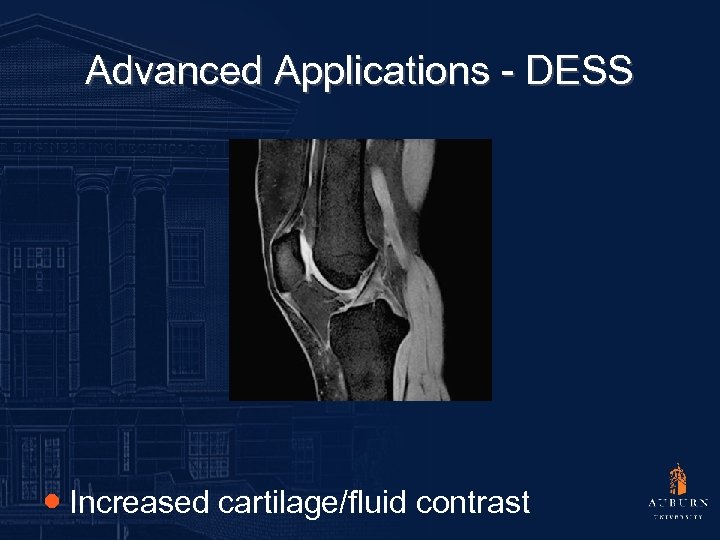 Advanced Applications - DESS ● Increased cartilage/fluid contrast 