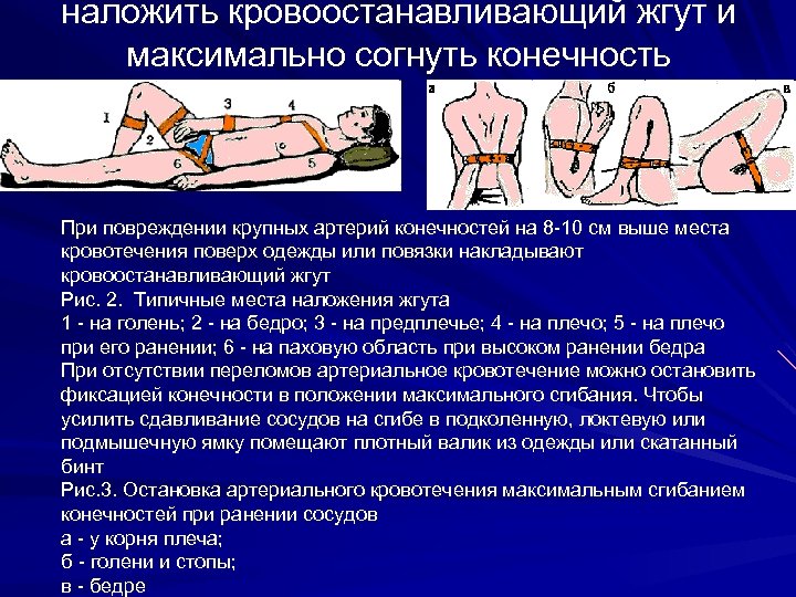 наложить кровоостанавливающий жгут и максимально согнуть конечность При повреждении крупных артерий конечностей на 8