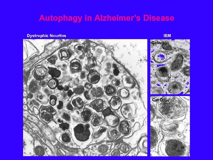 Autophagy in Alzheimer’s Disease Dystrophic Neurites IEM Calnexin Cat D 