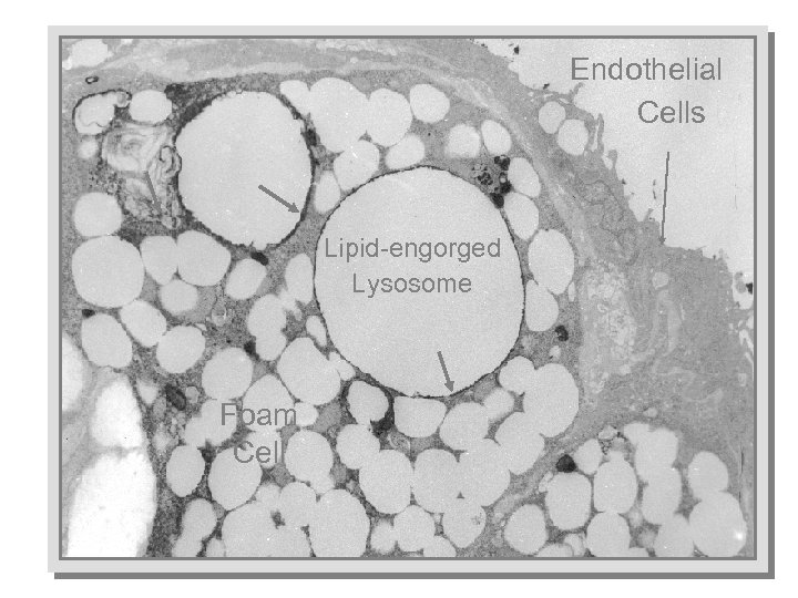Endothelial Cells Lipid-engorged Lysosome Foam Cell 