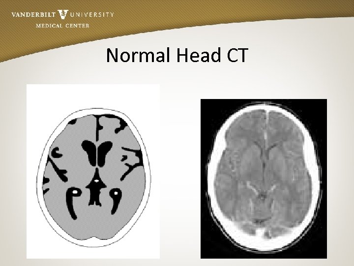 Normal Head CT 