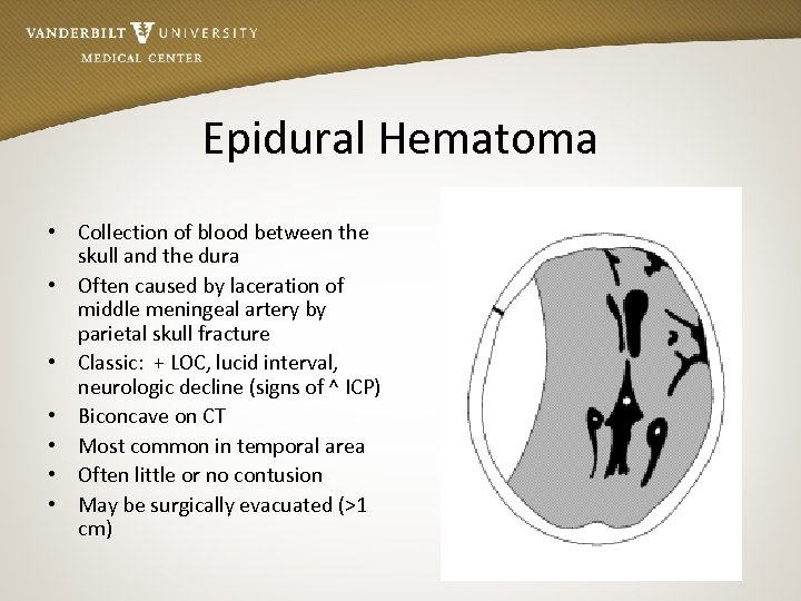 Epidural Hematoma • Collection of blood between the skull and the dura • Often