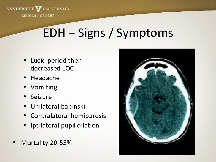 EDH – Signs / Symptoms • Lucid period then decreased LOC • Headache •