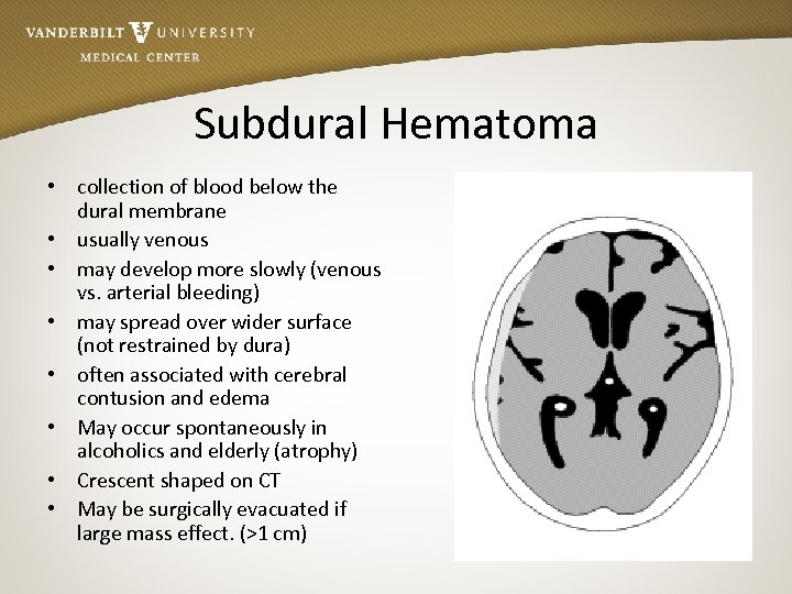 Subdural Hematoma • collection of blood below the dural membrane • usually venous •