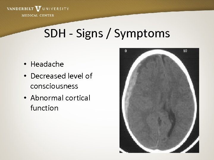 SDH - Signs / Symptoms • Headache • Decreased level of consciousness • Abnormal