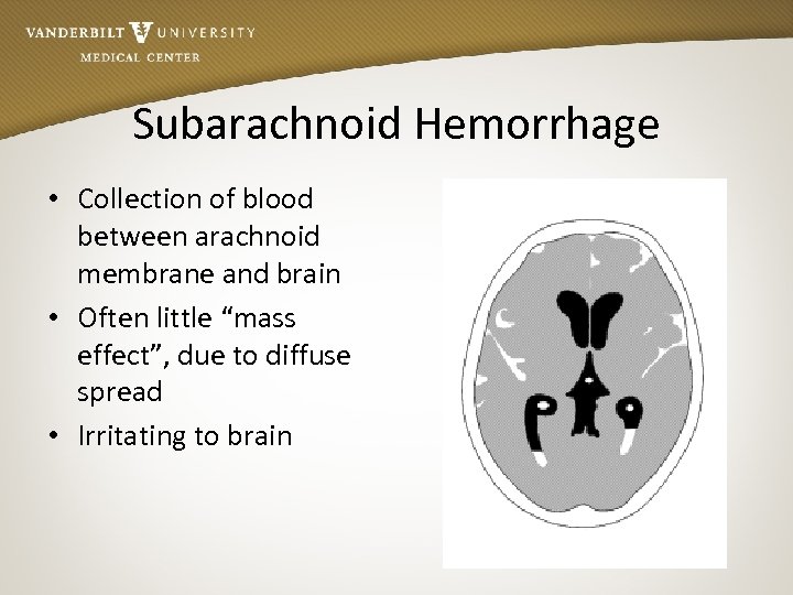 Subarachnoid Hemorrhage • Collection of blood between arachnoid membrane and brain • Often little