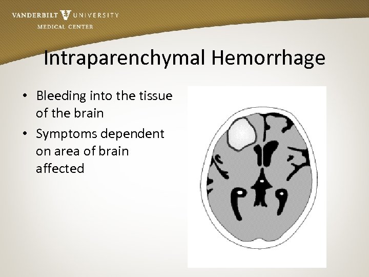 Intraparenchymal Hemorrhage • Bleeding into the tissue of the brain • Symptoms dependent on