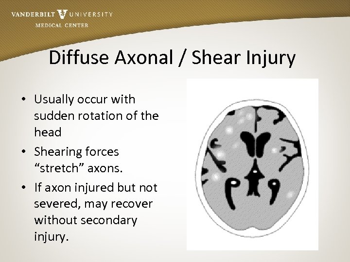 Diffuse Axonal / Shear Injury • Usually occur with sudden rotation of the head