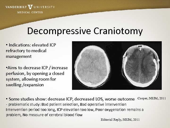 Decompressive Craniotomy • Indications: elevated ICP refractory to medical management • Aims to decrease