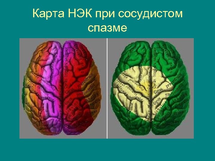 Карта НЭК при сосудистом спазме 