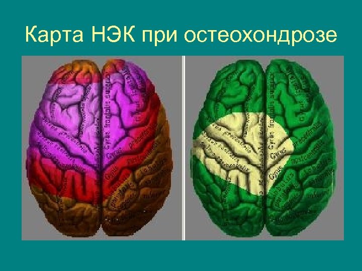 Карта НЭК при остеохондрозе 