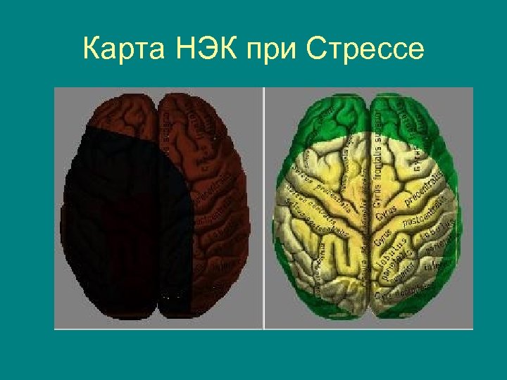 Карта НЭК при Стрессе 