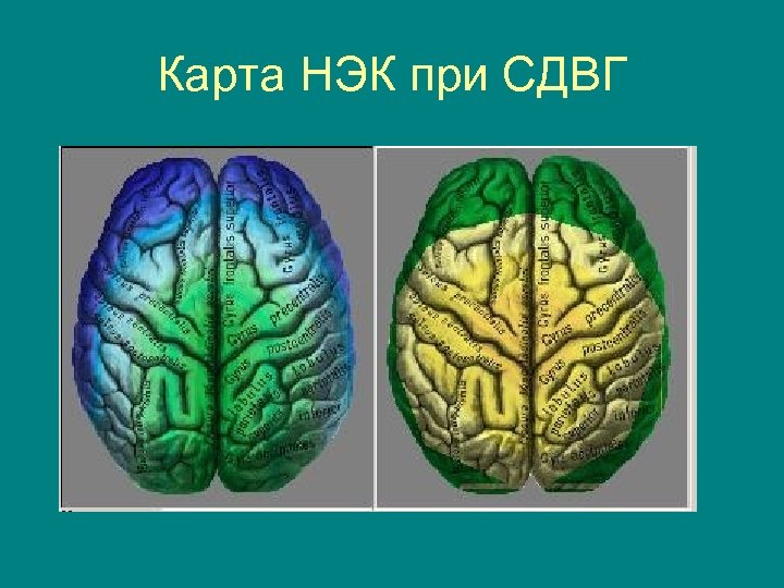 Карта НЭК при СДВГ 