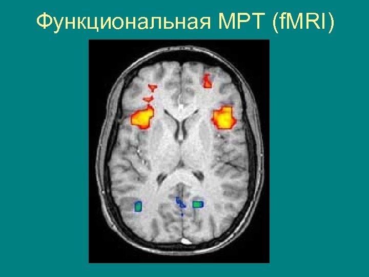 Функциональная МРТ (f. MRI) 