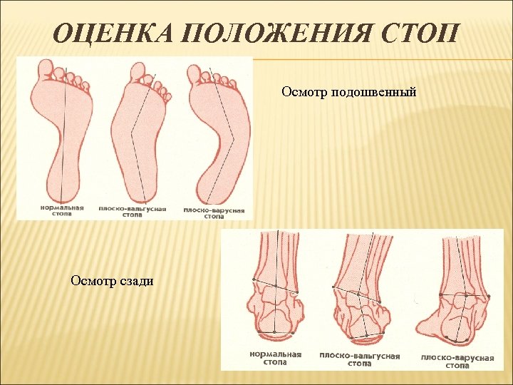 Рассмотрите рисунок с изображением стопы человека как называют нарушение формы стопы