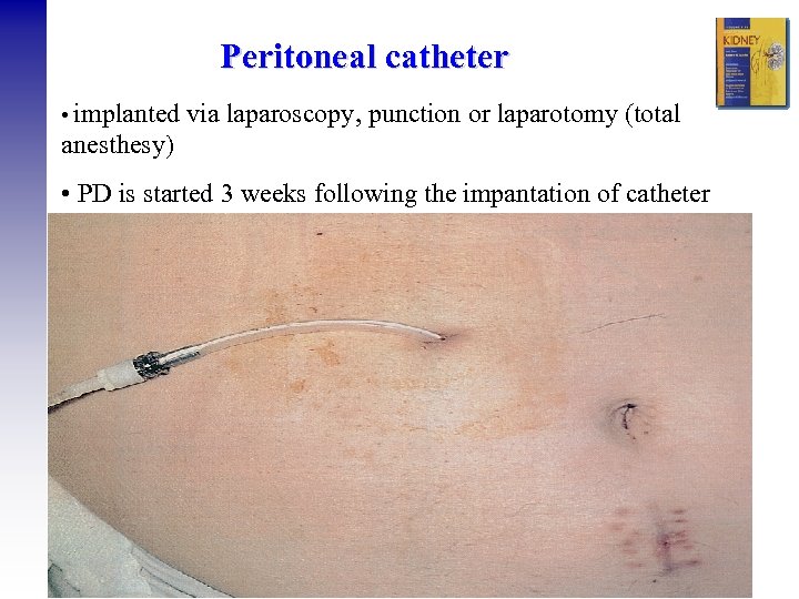 Peritoneal catheter • implanted via laparoscopy, punction or laparotomy (total anesthesy) • PD is