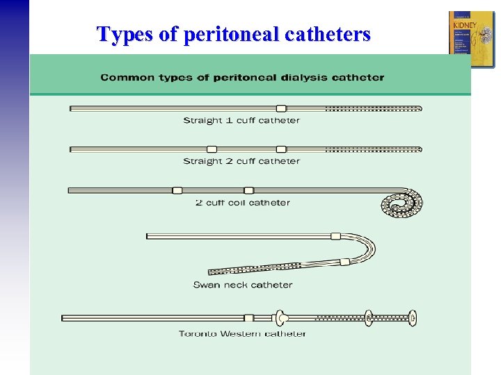 Types of peritoneal catheters 