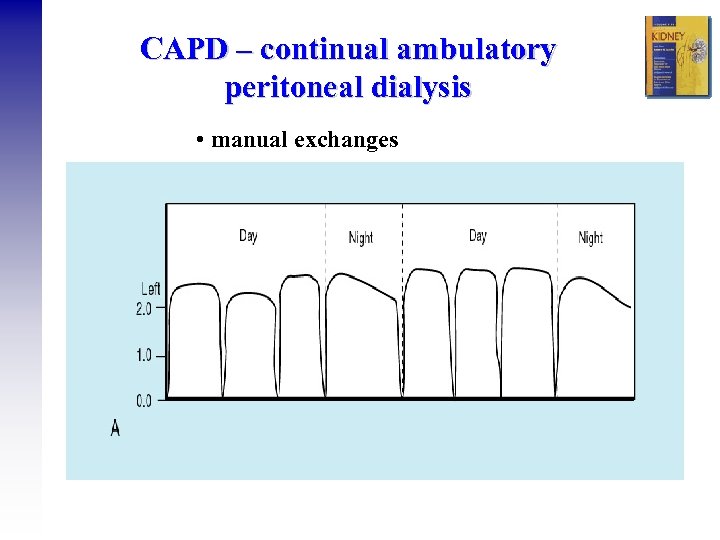 CAPD – continual ambulatory peritoneal dialysis • manual exchanges 