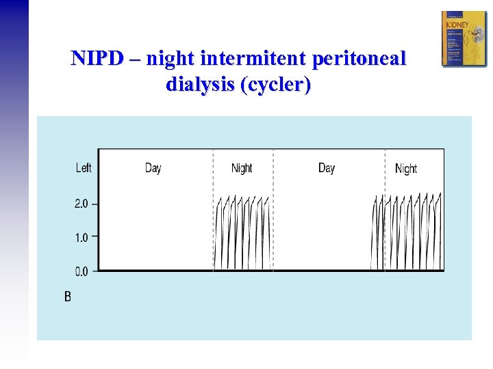 NIPD – night intermitent peritoneal dialysis (cycler) 