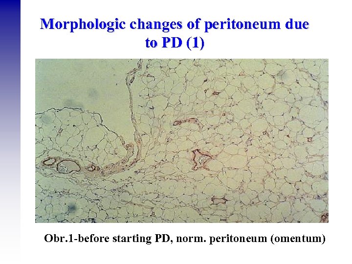 Morphologic changes of peritoneum due to PD (1) Obr. 1 -before starting PD, norm.