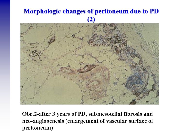 Morphologic changes of peritoneum due to PD (2) Obr. 2 -after 3 years of