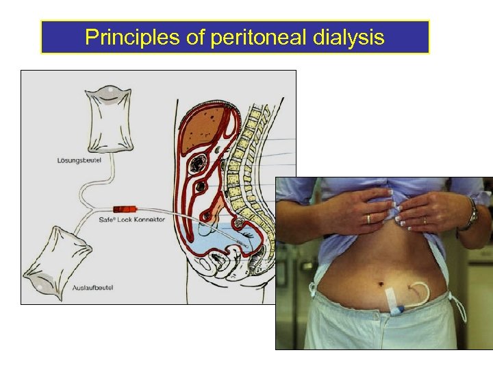 Principles of peritoneal dialysis 