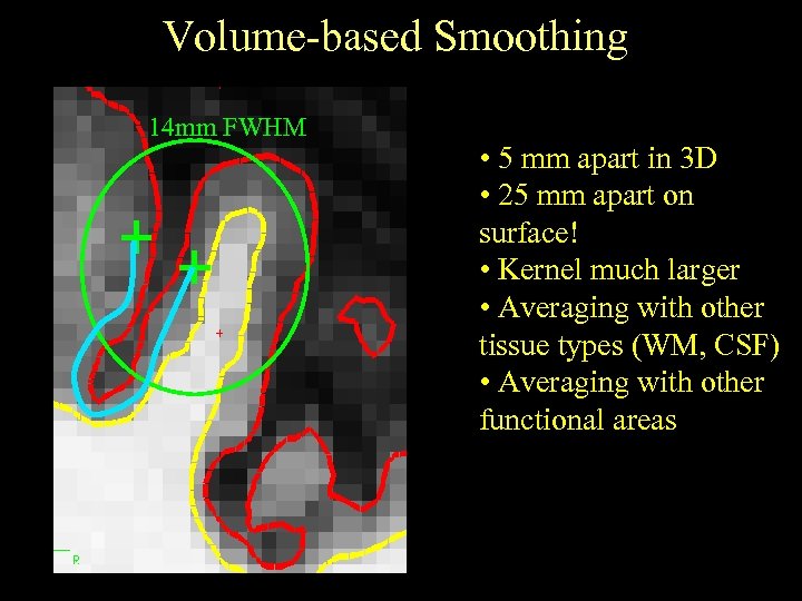 Volume-based Smoothing 14 mm FWHM • 5 mm apart in 3 D • 25