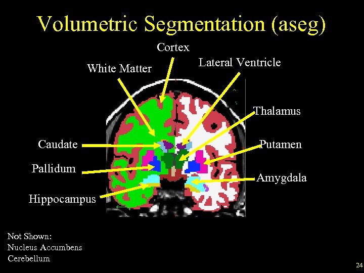 Volumetric Segmentation (aseg) Cortex White Matter Lateral Ventricle Thalamus Caudate Pallidum Putamen Amygdala Hippocampus
