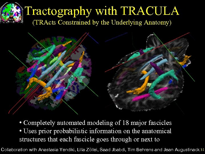 Tractography with TRACULA (TRActs Constrained by the Underlying Anatomy) • Completely automated modeling of