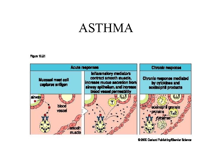 ASTHMA 