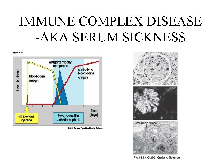 IMMUNE COMPLEX DISEASE -AKA SERUM SICKNESS 