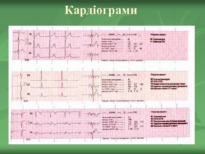 Кардіограми 