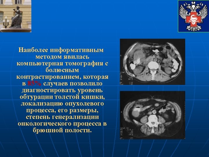 Наиболее информативным методом явилась компьютерная томография с болюсным контрастированием, которая в 85% случаев позволило