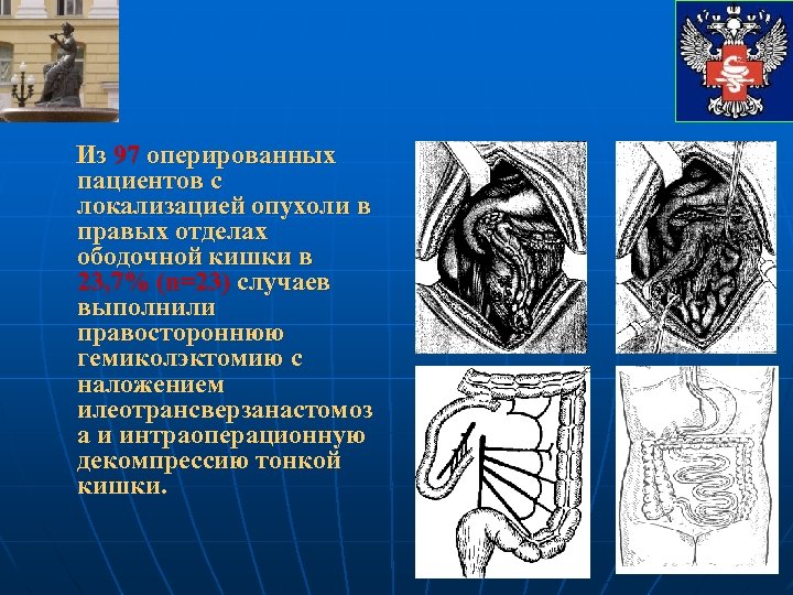 Из 97 оперированных пациентов с локализацией опухоли в правых отделах ободочной кишки в 23,