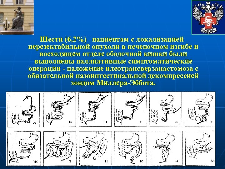 Шести (6, 2%) пациентам с локализацией нерезектабильной опухоли в печеночном изгибе и восходящем отделе