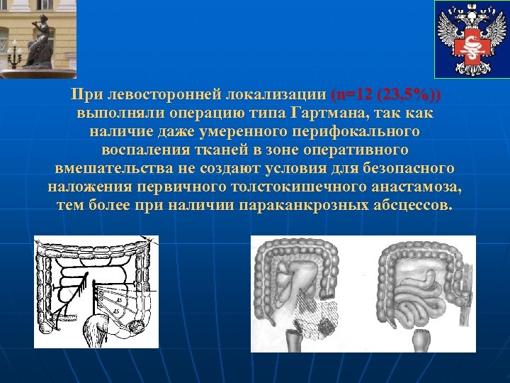 При левосторонней локализации (n=12 (23, 5%)) выполняли операцию типа Гартмана, так как наличие даже