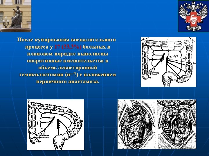 После купирования воспалительного процесса у 17 (33, 3%) больных в плановом порядке выполнены оперативные