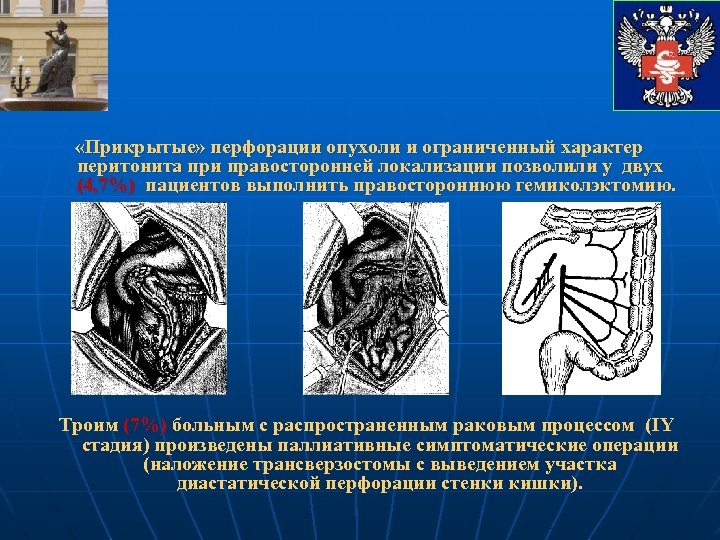  «Прикрытые» перфорации опухоли и ограниченный характер перитонита при правосторонней локализации позволили у двух