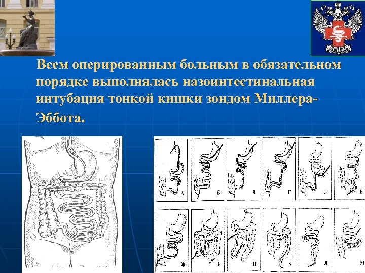 Всем оперированным больным в обязательном порядке выполнялась назоинтестинальная интубация тонкой кишки зондом Миллера. Эббота.