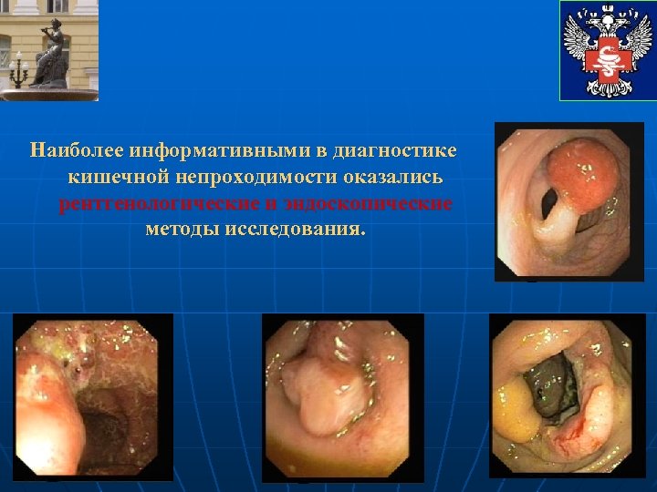 Наиболее информативными в диагностике кишечной непроходимости оказались рентгенологические и эндоскопические методы исследования. 