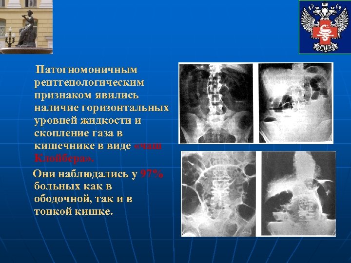 Патогномоничным рентгенологическим признаком явились наличие горизонтальных уровней жидкости и скопление газа в кишечнике в