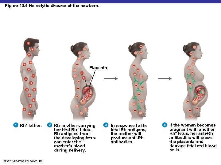 Figure 19. 4 Hemolytic disease of the newborn. Placenta Rh+ father. © 2013 Pearson