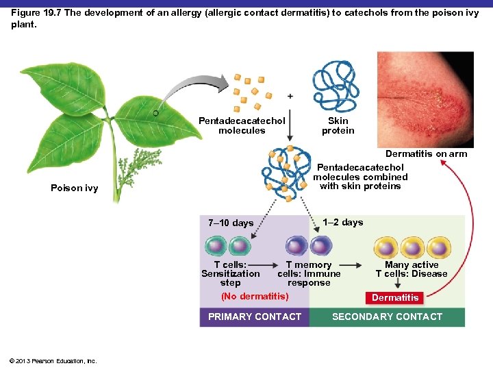 Figure 19. 7 The development of an allergy (allergic contact dermatitis) to catechols from
